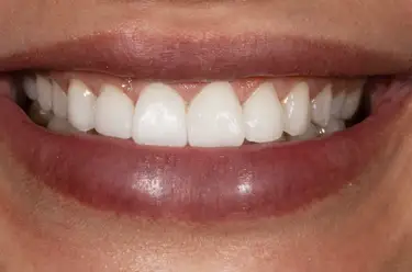 What are White Fillings Made Of? Image