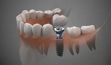 Dental Implants Image
