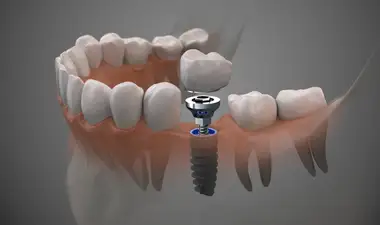 Dental Implants Image