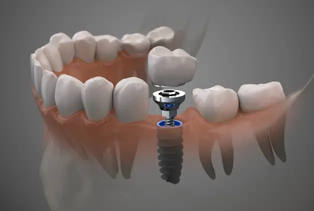 single tooth implant