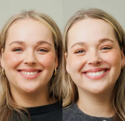before and after smile - cosmetic dentist london