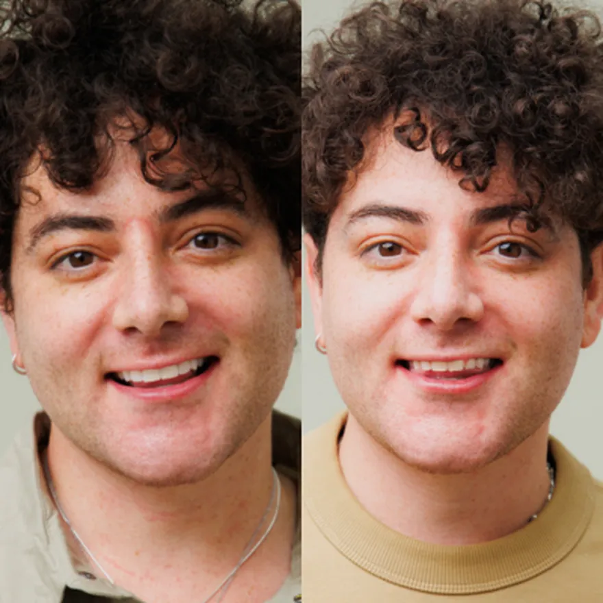 Causes of Malocclusion