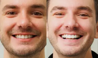 Teeth whitening Image