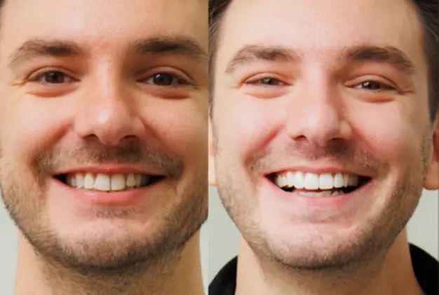 Before and After Ceramic Braces
