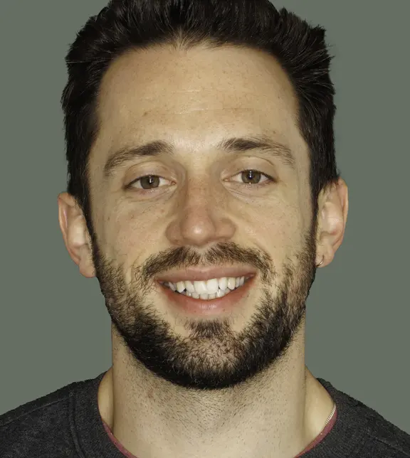 Invisalign - before - Tom - The Modern Dentist