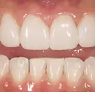New Teeth after Orthodontics Treatment
