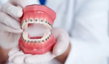 Metal braces Image