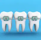 Orthodontics Treatment (Fitting Your Braces)