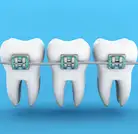 Orthodontics Treatment (Fitting Your Braces)