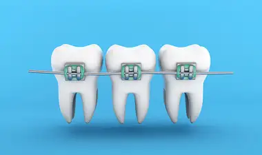 Adult Braces Image