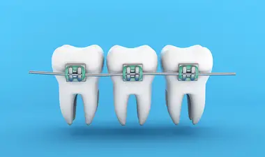 Adult Braces Image