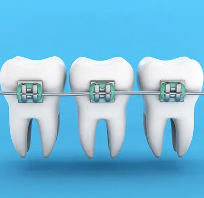 Orthodontics Treatment (Fitting Your Braces)