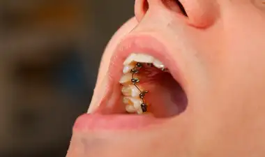 Lingual braces Image