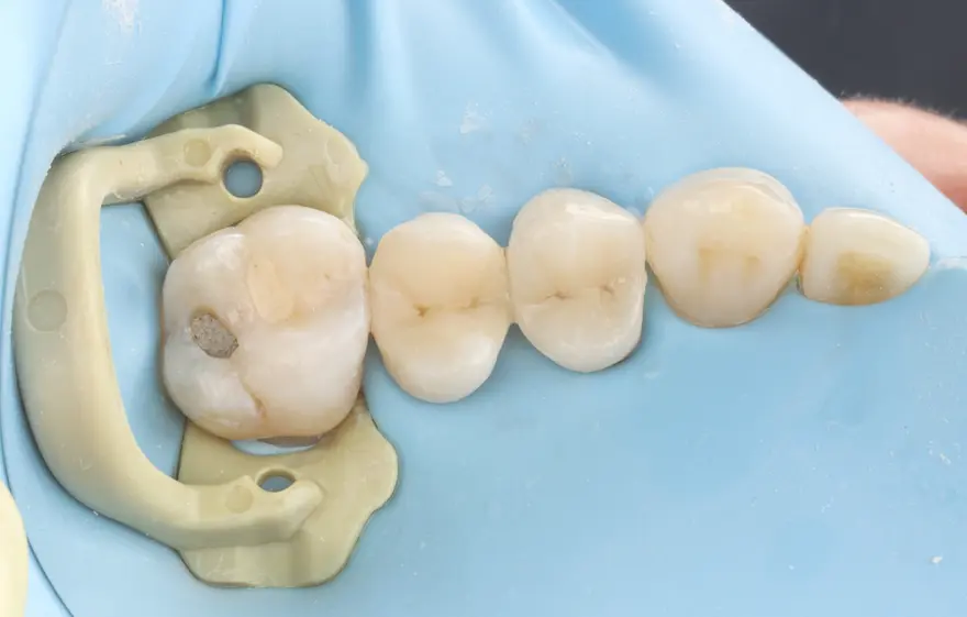 White Fillings