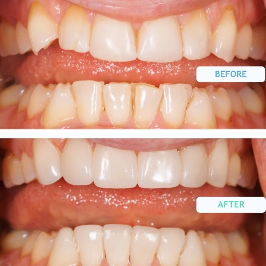 Composite Bonding On Crooked Teeth Before and After