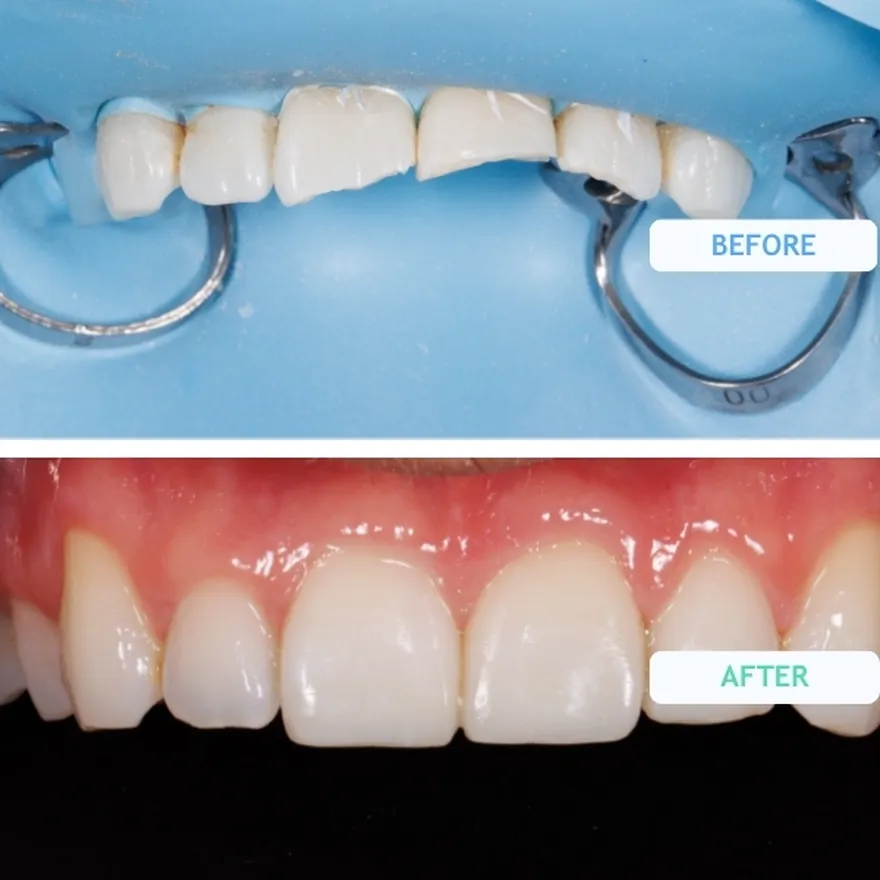 Composite Bonding on Chipped or Broken Teeth Before and After