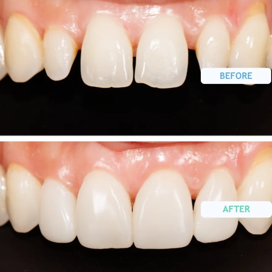 Composite Bonding On Gaps In Teeth Before and After