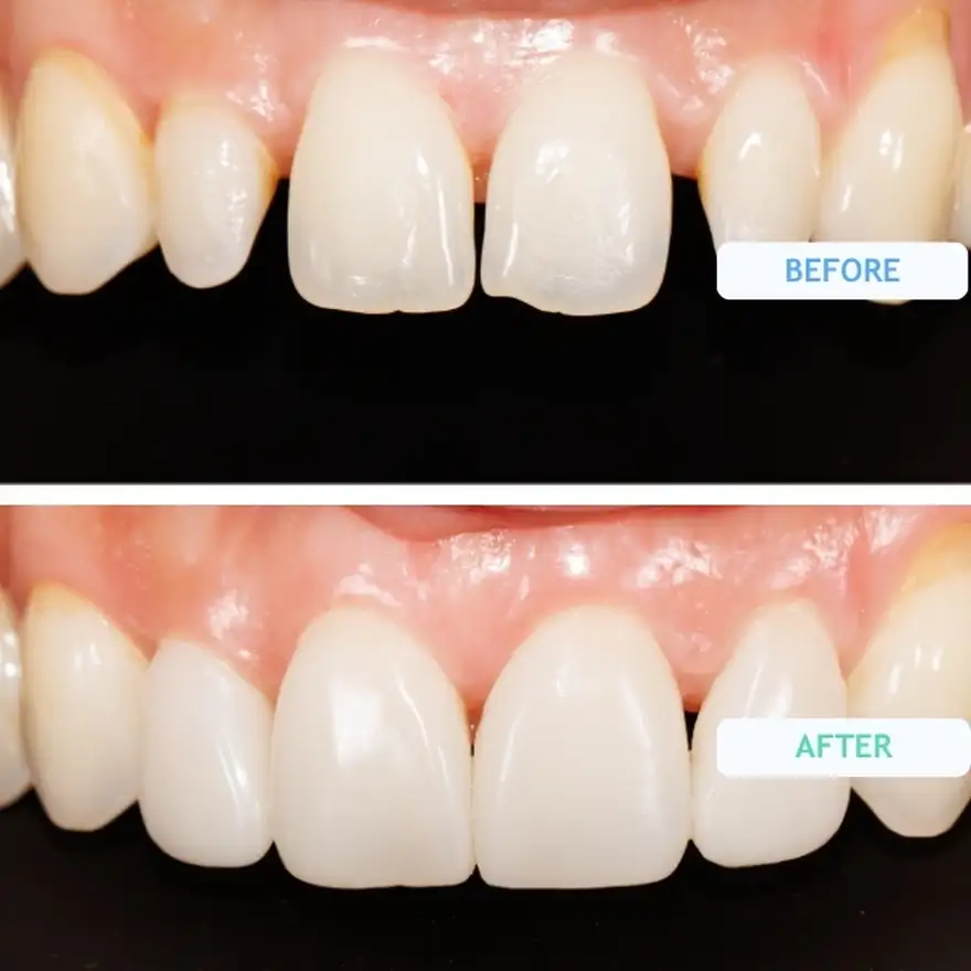 Composite Bonding On Gaps In Teeth Before and After