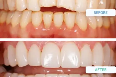 Composite Bonding On Bottom Teeth Before and After