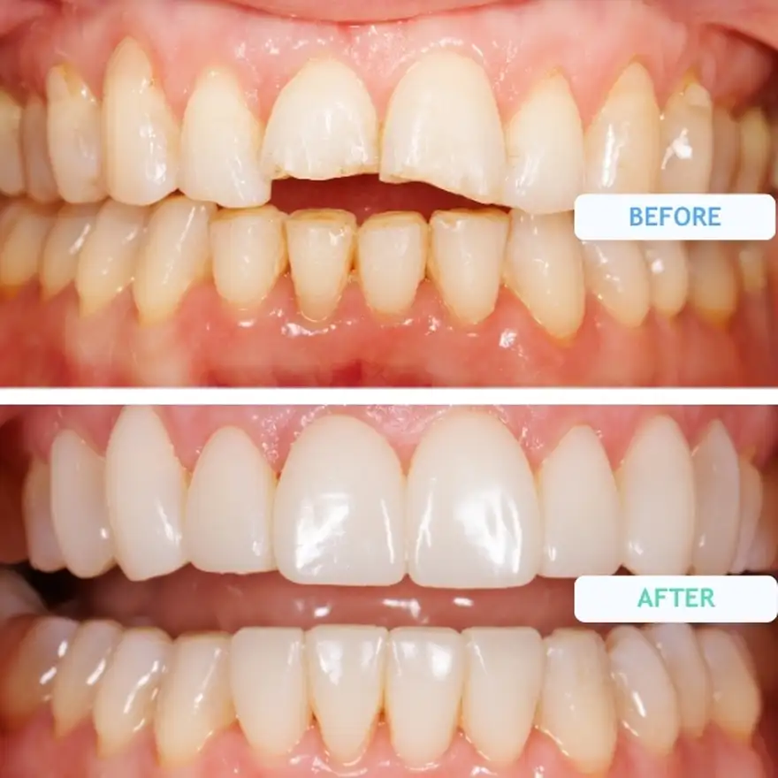 Composite Bonding On Bottom Teeth Before and After