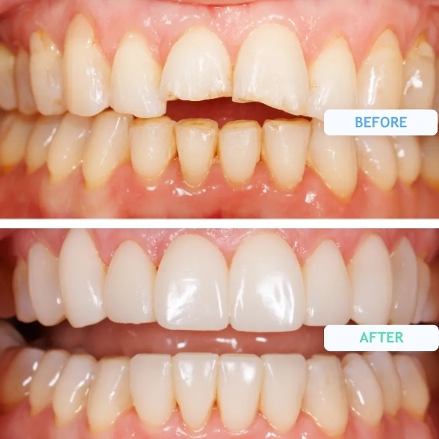Composite Bonding On Overlapping Teeth Before and After