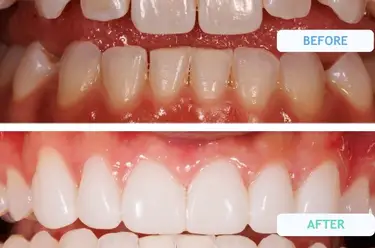 Can You Whiten Your Teeth After Composite Bonding? Image