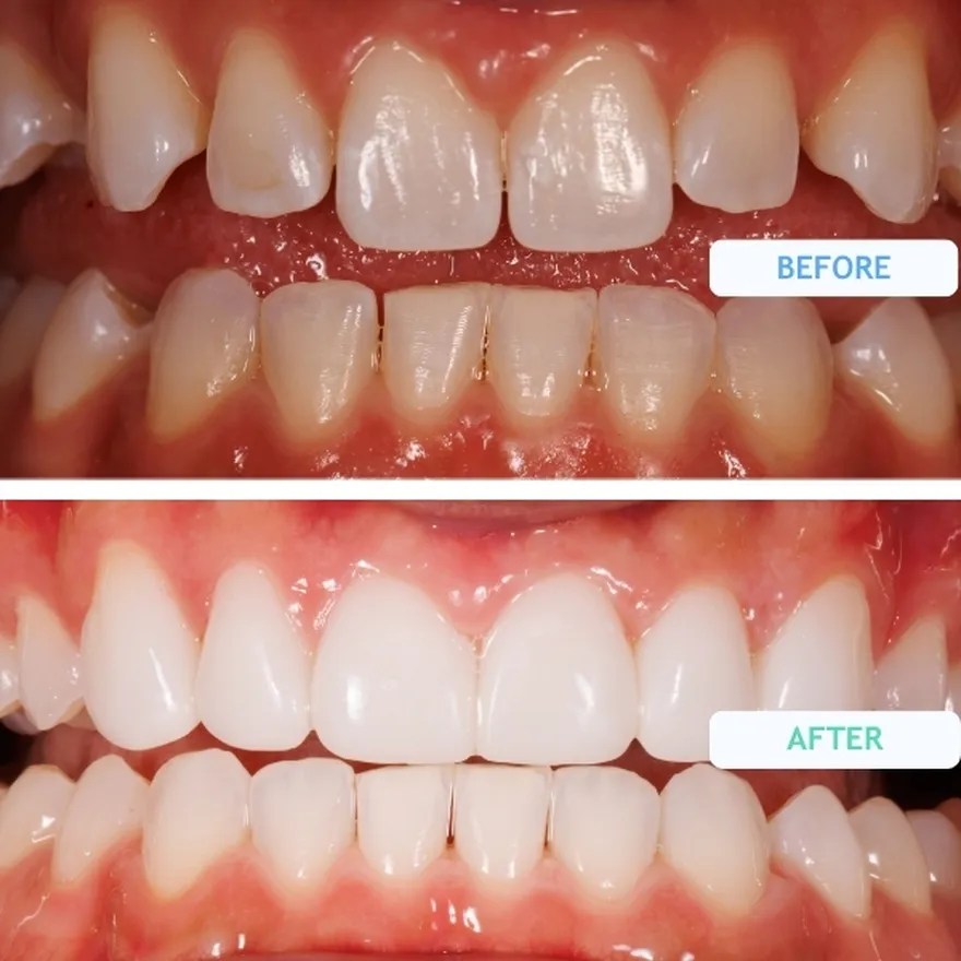 Composite Bonding On Front Teeth Before And After
