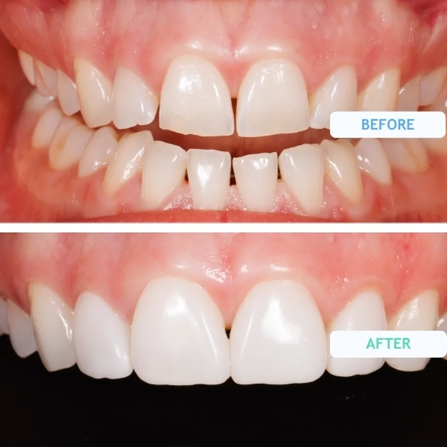Composite Bonding On Small Teeth Before And After
