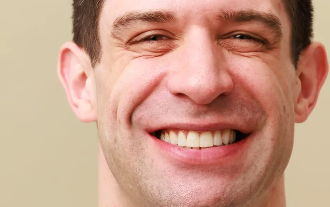 Piers Orthdontics after - The Modern Dentist