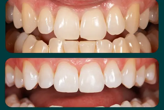 Teeth Whitening Before And After