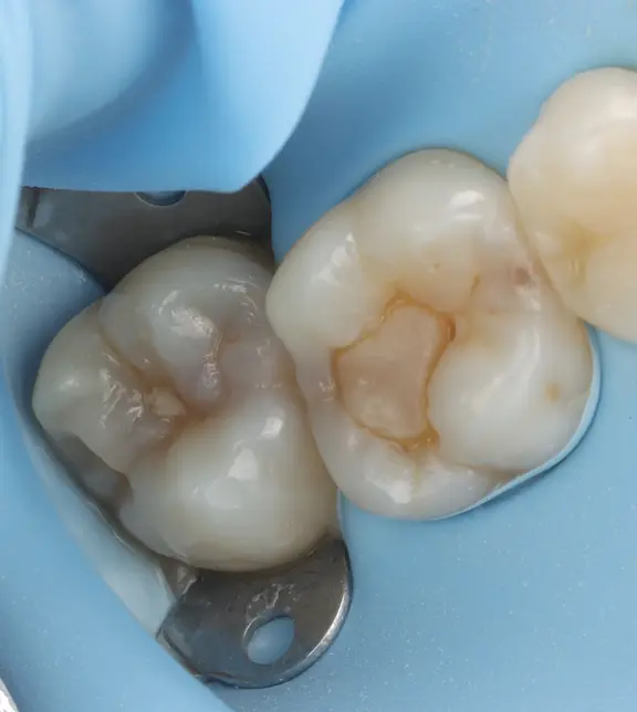 Teeth under rubber dam before treatment