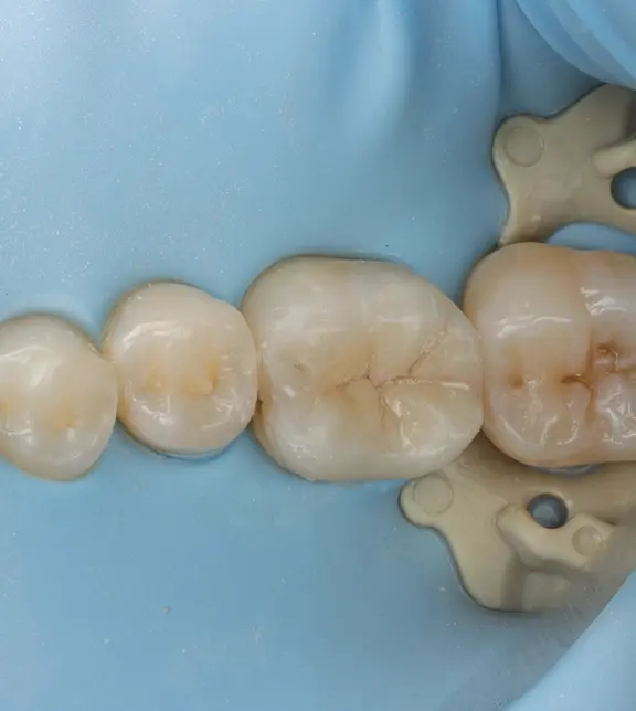 Tooth following restoration
