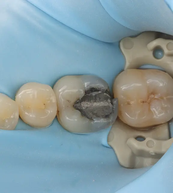 Tooth under rubber dam before treatment