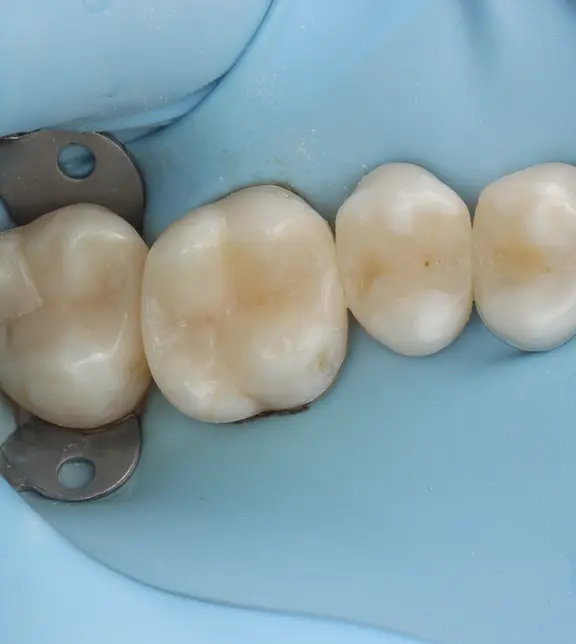 Teeth following restoration