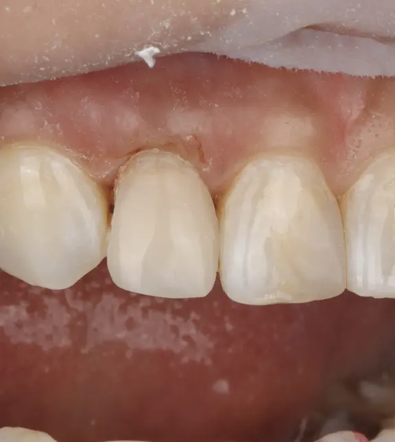 Tooth following emergency restoration