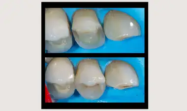 Inlays and Onlays Image