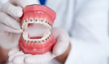 Metal Braces Image