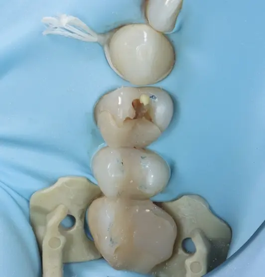 Tooth under rubber dam before treatment