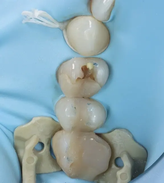 Tooth under rubber dam before treatment