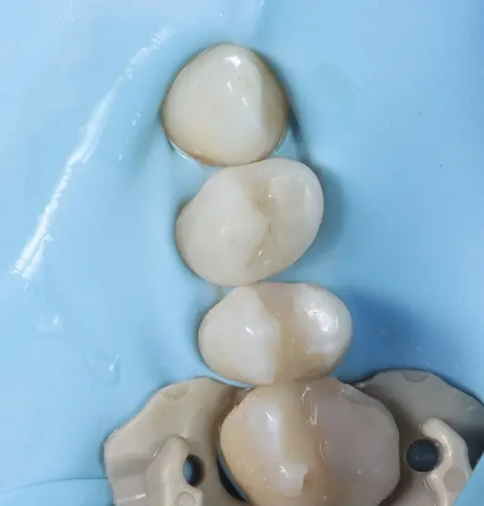 Tooth following restoration