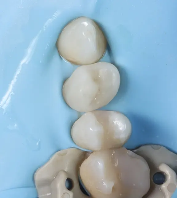 Tooth following restoration