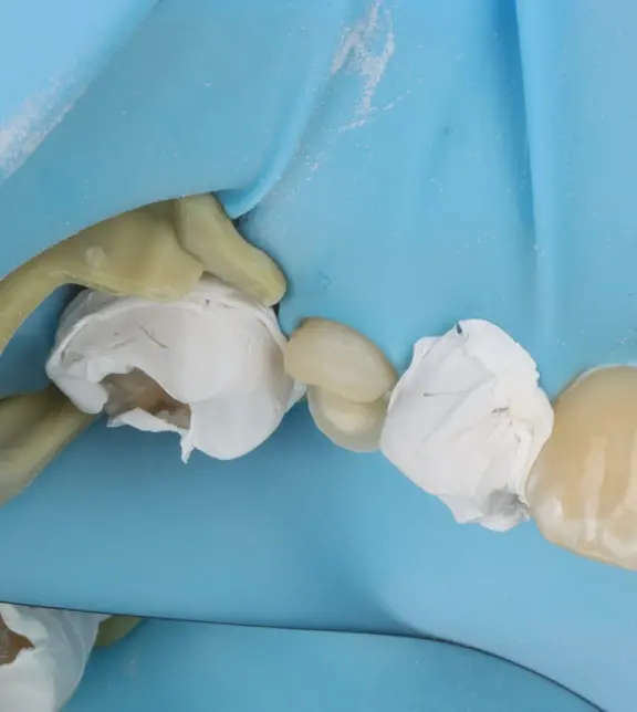 Before Cementation