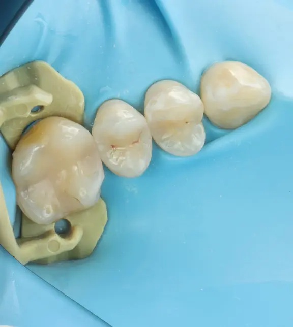 Final appearance of tooth