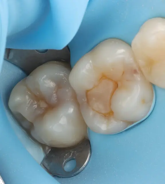 Teeth under rubber dam before treatment