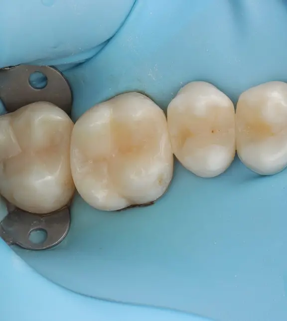 Teeth following restoration