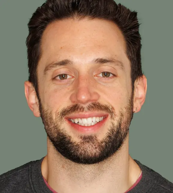Invisalign - before - Tom Foley - The Modern Dentist