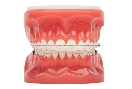 What Are Ceramic Braces?