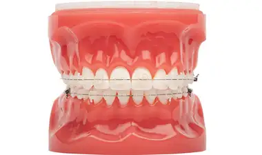 Ceramic Braces Image