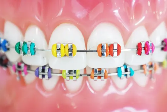 What Colour Braces Are Available?